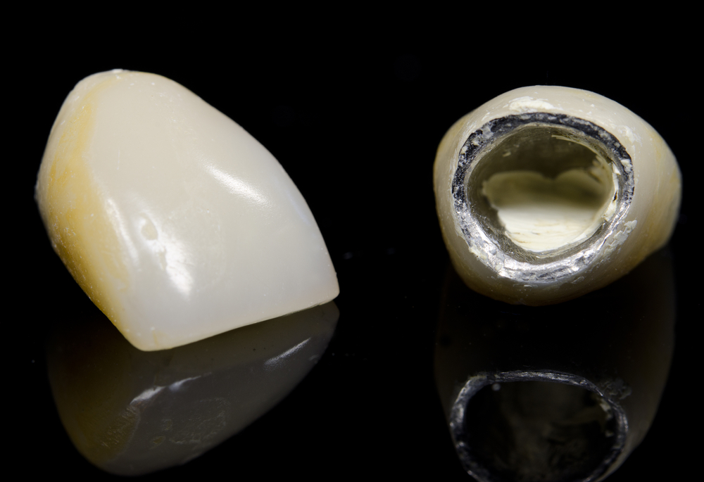 porcelain fused to metal crowns